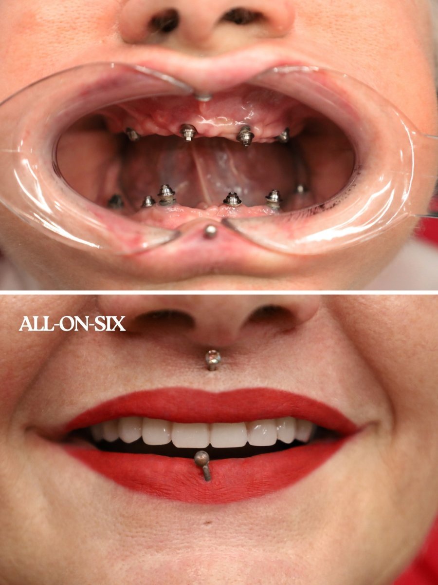 Resultados antes y después de implantes dentales All-on-6 en WestDent Clinic, sonrisa restaurada