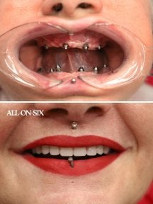 Before and after All-on-6 dental implant results at WestDent Clinic, full smile restoration