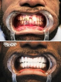 Before and after zirconia crown installation at WestDent Clinic – smile restoration results