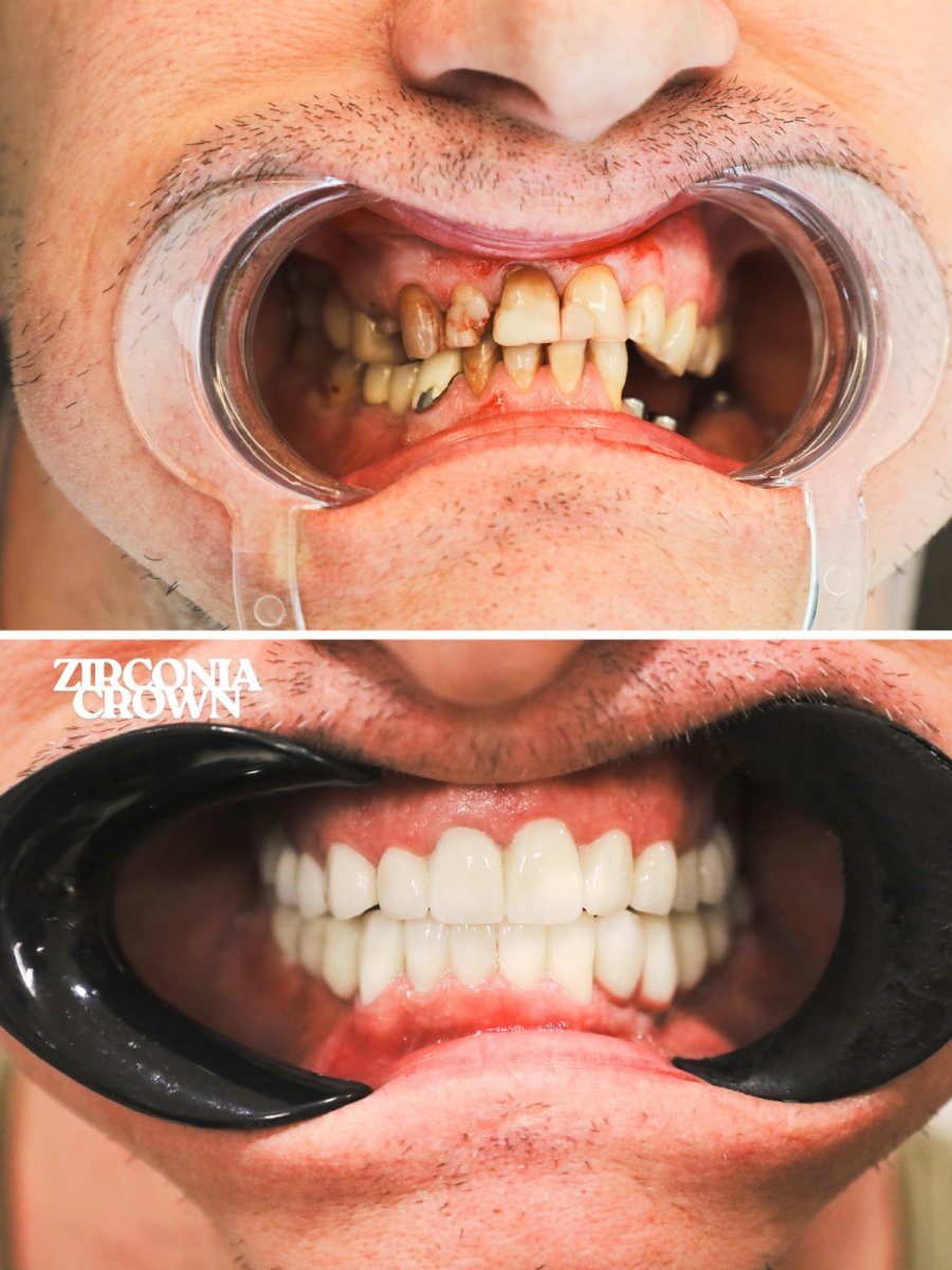 قبل وبعد تركيب تيجان الزركونيا في WestDent Clinic – نتائج استعادة الابتسامة