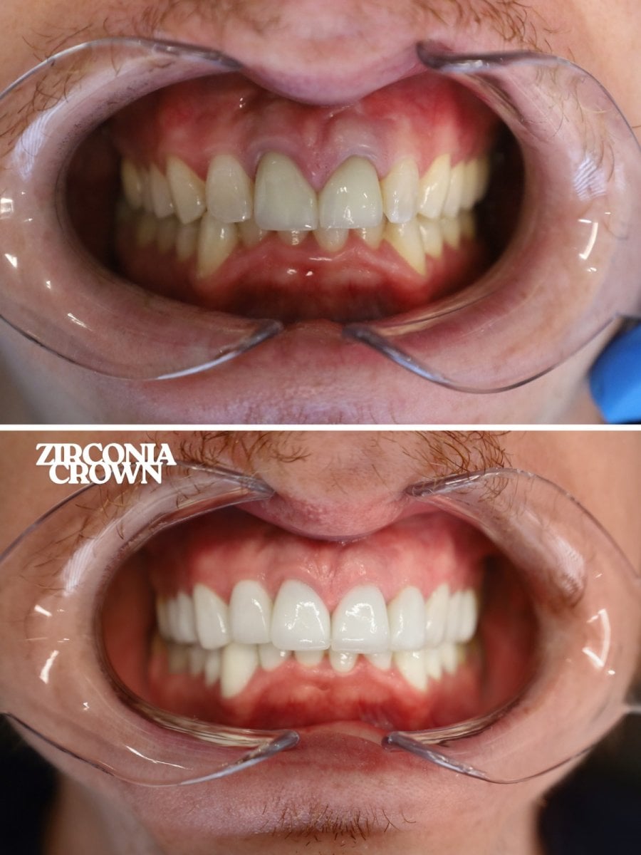 قبل وبعد تركيب تيجان الزركونيا في WestDent Clinic – تحسين جمالية الابتسامة