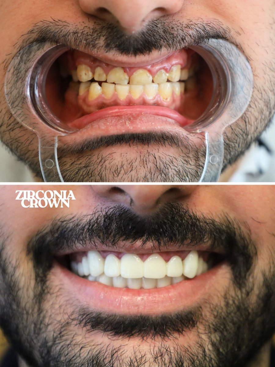 نتائج قبل وبعد تركيب تيجان الزركونيا في WestDent Clinic – تحسين مظهر الابتسامة