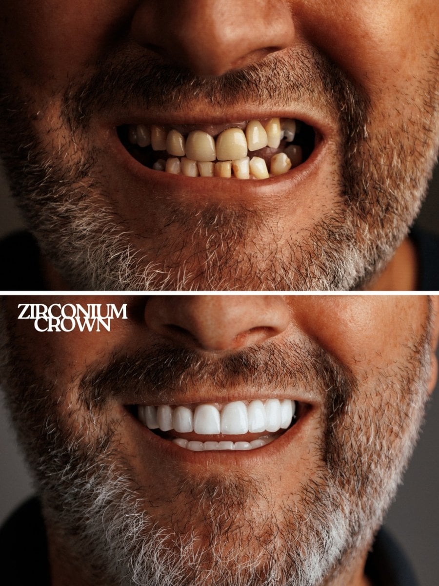 Resultados antes y después de coronas de zirconio en WestDent Clinic – transformación de sonrisa