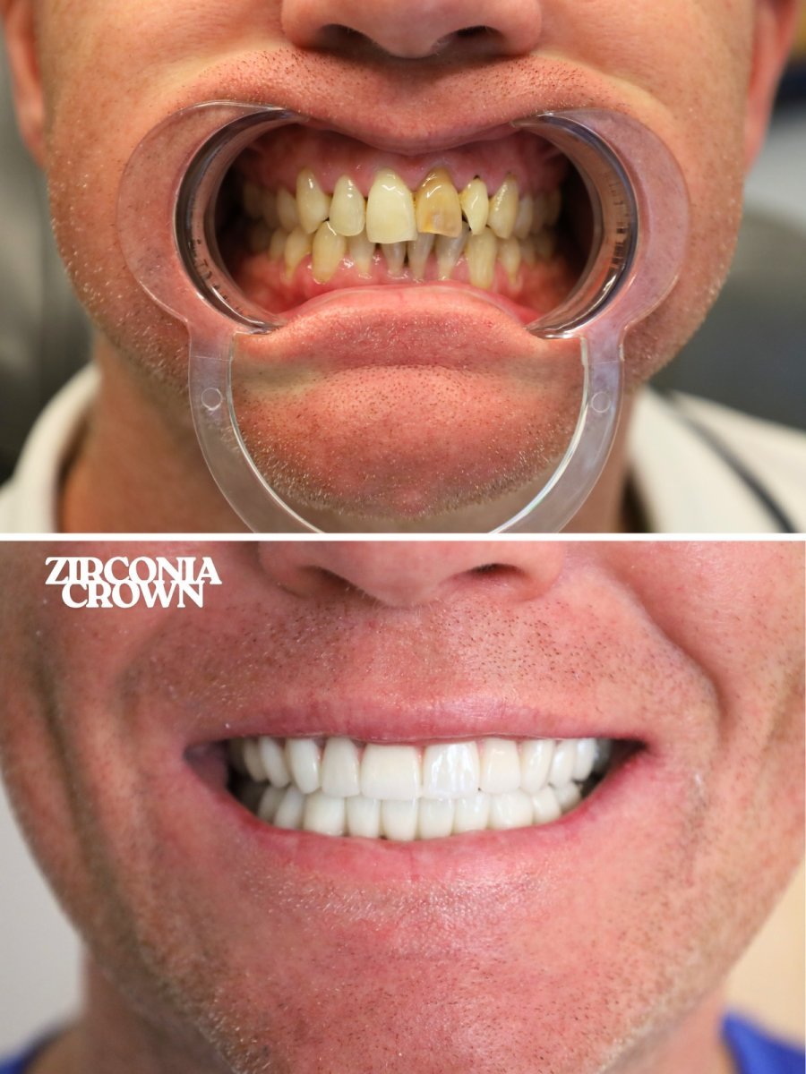 Before and after zirconia crown results at WestDent Clinic – smile makeover with natural look