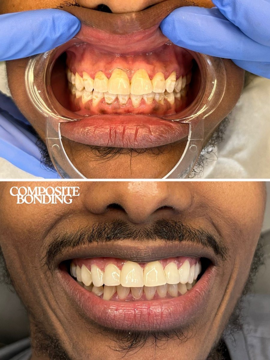 Vorher-nachher-Ergebnis Komposit-Veneers bei WestDent Clinic, verbesserte Ästhetik