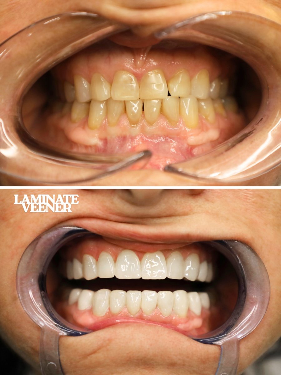 نتائج قبل وبعد فينير الأسنان في WestDent Clinic – تحسين جمالية الابتسامة