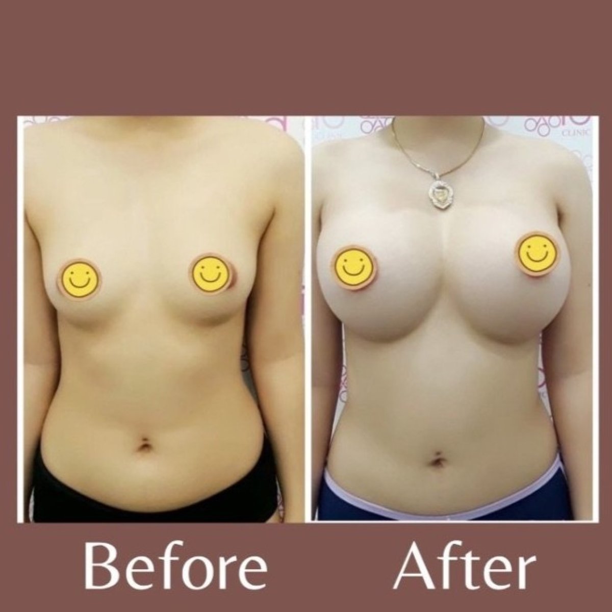 نتائج تكبير الثدي قبل وبعد في ID Clinic Bangkok – زيادة حجم الثدي