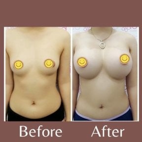 Результаты до и после увеличения груди в ID Clinic Bangkok – увеличенный объем груди