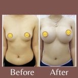 Результаты до и после увеличения груди в ID Clinic Bangkok – увеличенный объем груди