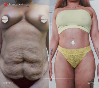 Vorher-nachher-Ergebnisse der Bauchliposuktion bei CE International Hospital, verbesserte Körperkontur