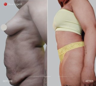 Vorher-nachher-Ergebnis der Bauchliposuktion in der CE International Hospital, schlankere Taille