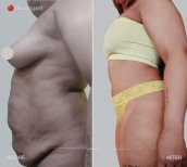 Vorher-nachher-Ergebnis der Bauchliposuktion in der CE International Hospital, schlankere Taille