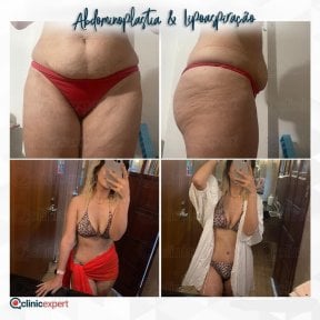 Vorher-nachher-Ergebnisse der Bauchliposuktion bei CE International Hospital, schlankere Taille