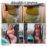 Vorher-nachher-Ergebnisse der Bauchliposuktion bei CE International Hospital, verbesserte Taille