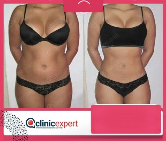 Vorher-nachher-Ergebnis der Bauchliposuktion bei CE International Hospital, schlankere Taille