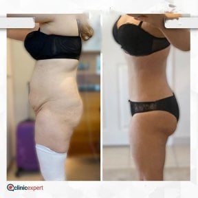 Vorher-nachher-Ergebnis der Bauchfettabsaugung bei CE International Hospital, schlankere Taille