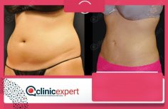Vorher-nachher-Ergebnisse der Bauchliposuktion bei CE International Hospital, schlankere Taille