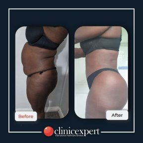 Before and after Brazilian Butt Lift results at CE International Hospital, enhanced body contour