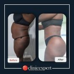 Before and after Brazilian Butt Lift results at CE International Hospital, enhanced body contour