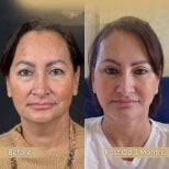 Facial fat transfer before and after results at Dr. Safa Manav Clinic, 3 months post-op
