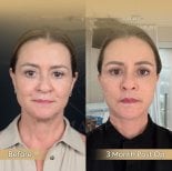 Facial fat transfer before and after results at Dr. Safa Manav Clinic, 3 months post-op