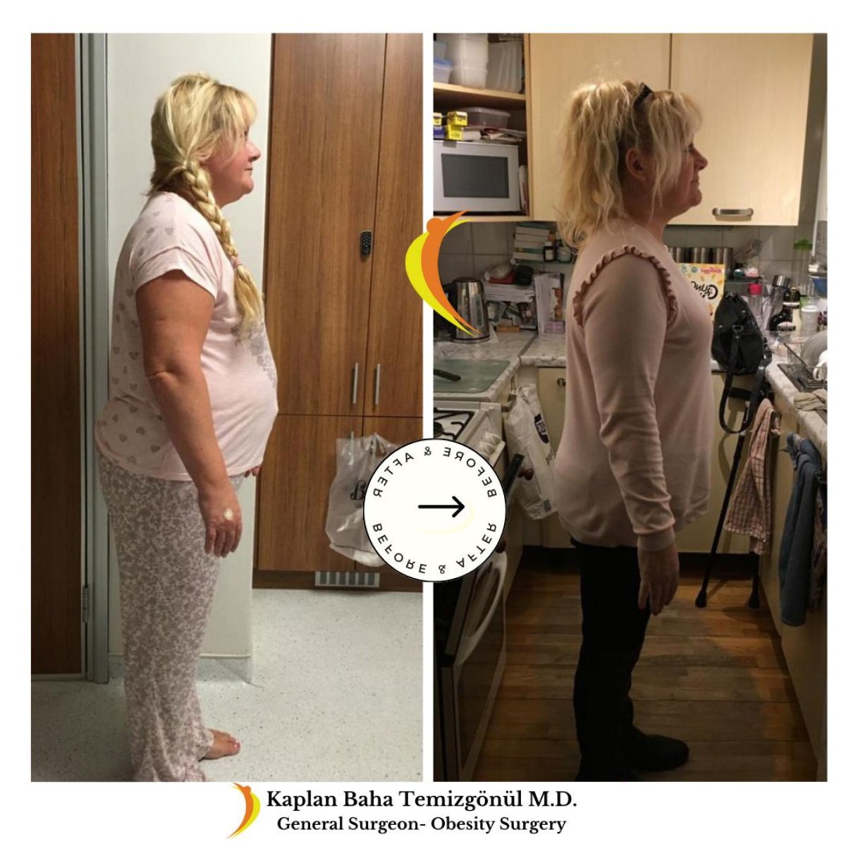 Resultados antes y después de bypass gástrico en Lotus Bariatrics Clinic – pérdida de peso visible