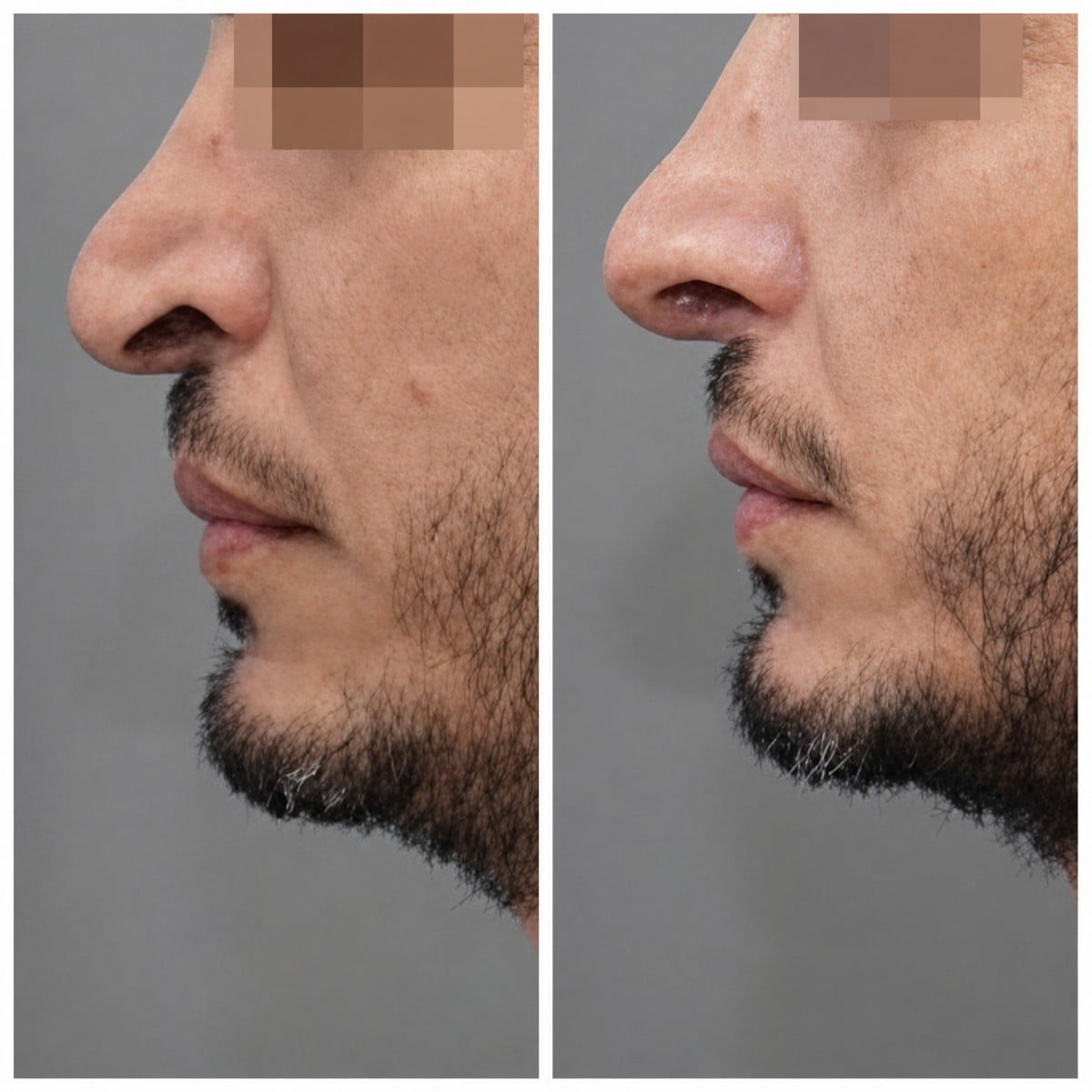 نتائج عملية تجميل الأنف قبل وبعد في مركز أسوتا الطبي، تحسين شكل الأنف الجانبي