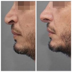Before and after rhinoplasty results at Assuta Medical Center, improved nose shape profile