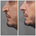Before and after rhinoplasty results at Assuta Medical Center, improved nose shape profile