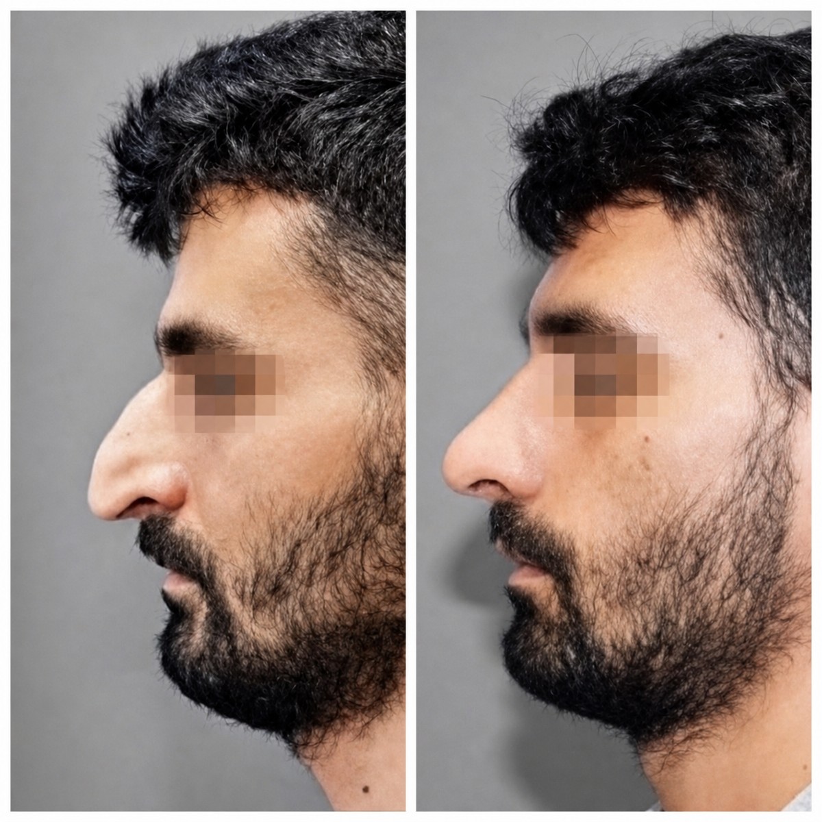 نتائج عملية تجميل الأنف قبل وبعد في مركز أسوتا الطبي، تحسين شكل الأنف والملف الجانبي