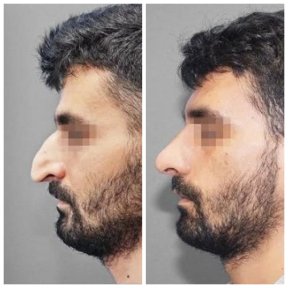 Before and after rhinoplasty results at Assuta Medical Center, improved nose shape and profile
