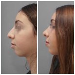 Before and after rhinoplasty results at Assuta Medical Center, improved nose profile