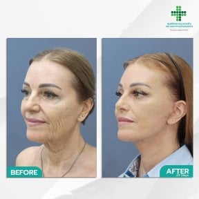 Facelift before and after results at Intrarat Hospital – visible facial rejuvenation and lift