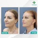 Facelift before and after results at Intrarat Hospital – visible facial rejuvenation and lift