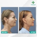 Before and after facelift results at Intrarat Hospital – visible facial rejuvenation after 23 days