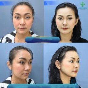 Facelift before and after results at Intrarat Hospital – visible facial rejuvenation outcome