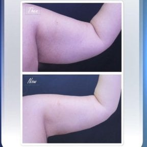 Before and after arm lift results at Asia Cosmetic Hospital, improved arm contour after brachioplasty