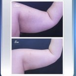 Before and after arm lift results at Asia Cosmetic Hospital, improved arm contour after brachioplasty