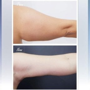 Before and after arm lift results at Asia Cosmetic Hospital, improved arm contour after brachioplasty