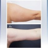 Before and after arm lift results at Asia Cosmetic Hospital, improved arm contour after brachioplasty