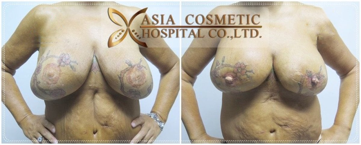 نتائج تصغير الحلمة قبل وبعد في Asia Cosmetic Hospital، تحسين مظهر الثدي