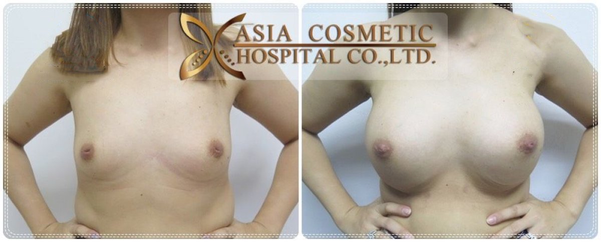 نتائج قبل وبعد تكبير الثدي في Asia Cosmetic Hospital، تحسين شكل الثدي