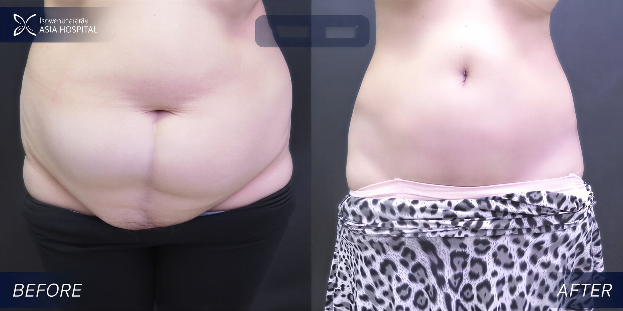 نتائج قبل وبعد عملية تجميل الأم في Asia Cosmetic Hospital – تحديد واضح للبطن