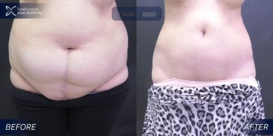 Mommy makeover before and after results at Asia Cosmetic Hospital – visible abdominal contouring