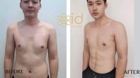 Before and after Vaser liposuction results at ID Clinic Bangkok, improved male body contour