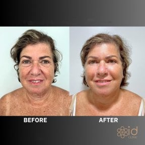 Facelift before and after results at ID Clinic Bangkok, visible facial rejuvenation and lift