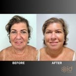 Facelift before and after results at ID Clinic Bangkok, visible facial rejuvenation and lift