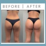 Before and after buttock lift results at ID Clinic Bangkok – enhanced contour and lift