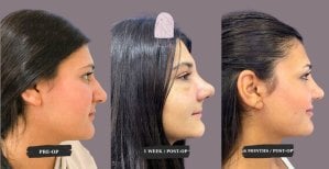 Septoplasty before and after results at Dr. MED – improved nasal profile and breathing function