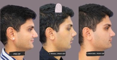 Before and after septoplasty results at Dr. MED – improved nasal profile and breathing